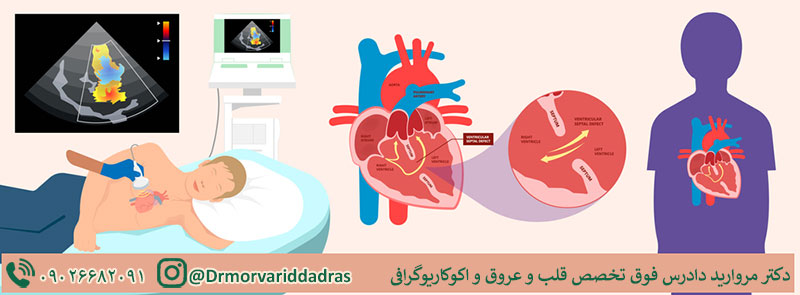 اکوکاردیوگرافی داپلر