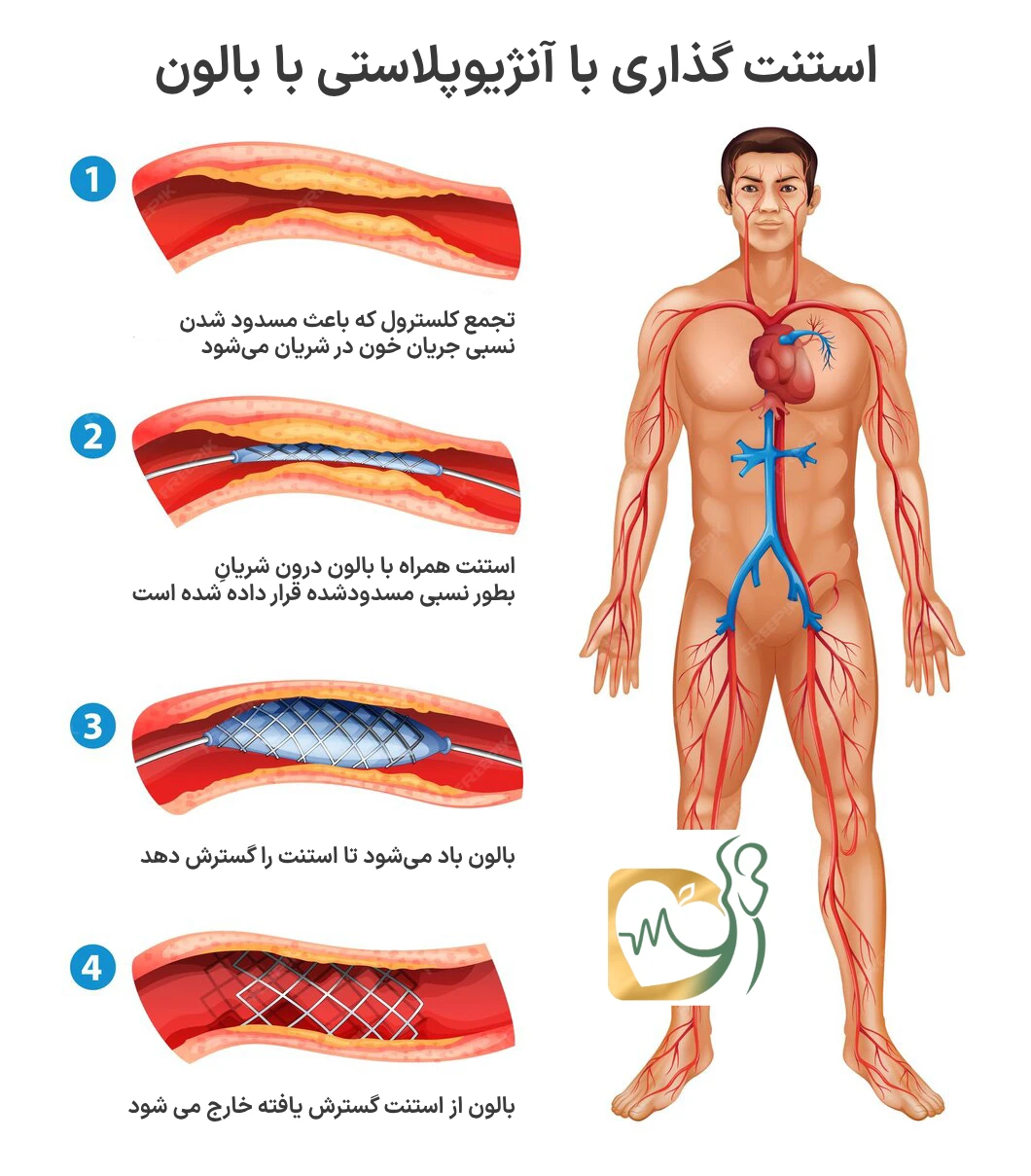 آنژیوپلاستی و استنت گذاری عروق کرونری قلب + فواید، ریکاوری و ریسک‌ها