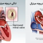 بررسی تفاوت افتادگی و تنگی دریچه ی میترال