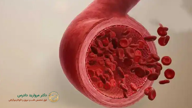 علت گشادی رگ قلب