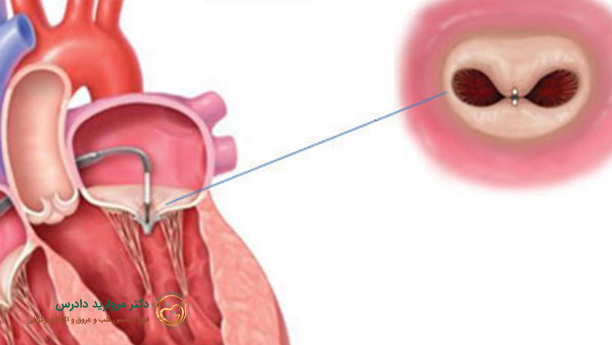 تصویری شماتیک از گشادی رگ قلب