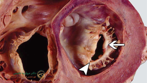 عکس تشخیص گشادی رگ قلب