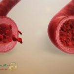 تصویری از مقایسه رگ قلب گشاد شده و نرمال