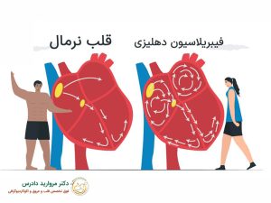 فیبریلاسیون دهلیزی چیست؟