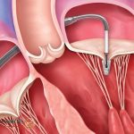 آیا نارسایی دریچه تریکوسپید قلب خطرناک است؟