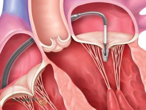 آیا نارسایی دریچه تریکوسپید قلب خطرناک است؟