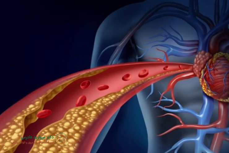 روش تشخیص بیماری آترواسکلروز