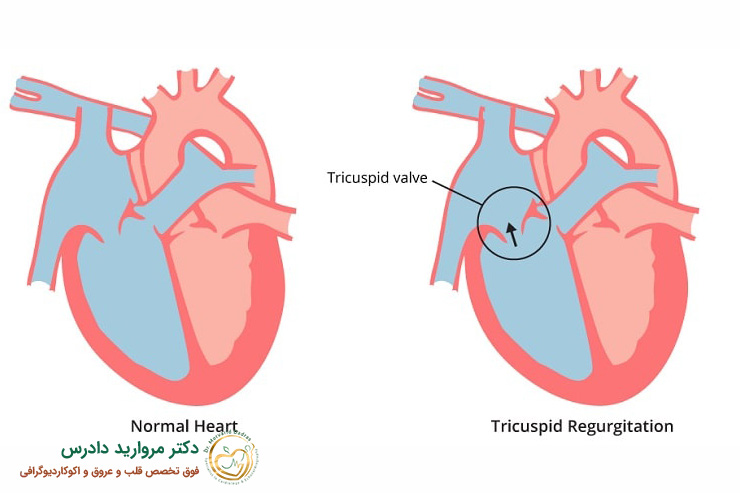 دریچه تریکوسپید قلب چه نقشی دارد؟