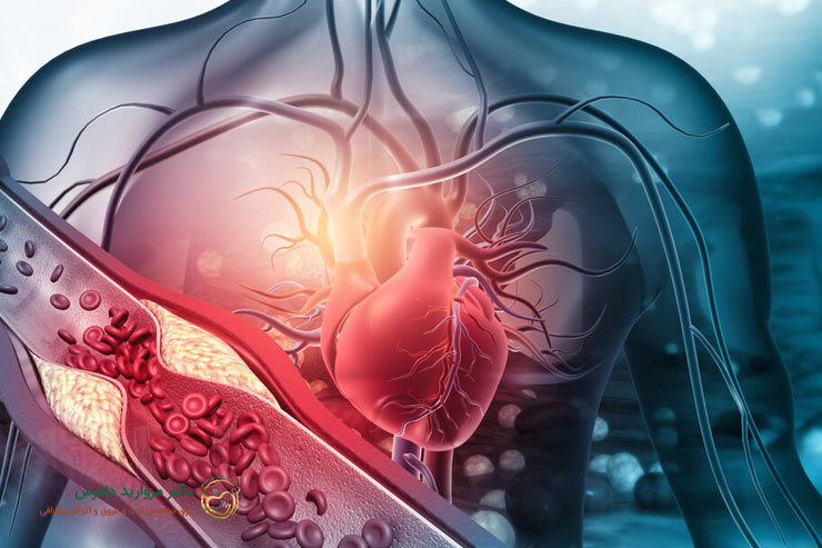 روش درمان آترواسکلروز
