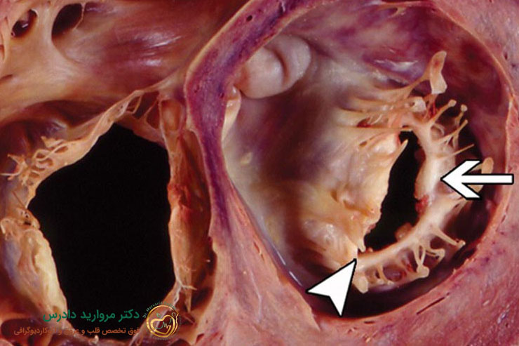 روش تشخیص نارسایی دریچه تریکوسپید قلب