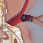 سندروم حاد کرونری