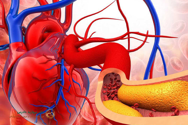 علائم بیماری آترواسکلروز