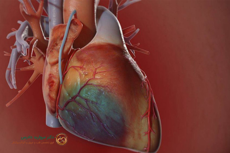 تصویری از قلب فردی که دچار سندرم کرونری حاد شده است