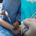 آنژیوگرافی از دست بهتر است یا پا