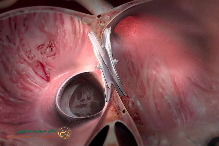 روش درمان سوراخ قلب