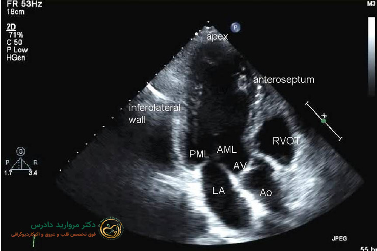 روش های تشخیص سوراخ قلب