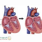 سوراخ قلب چیست؟