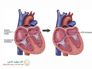 سوراخ قلب چیست؟